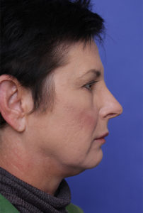 Facelift Before & After Image