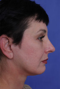 Facelift Before & After Image