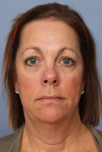 Facelift Before & After Image