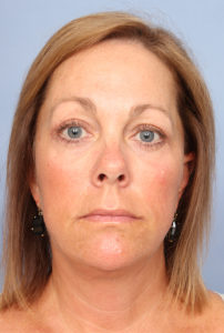 Facelift Before & After Image