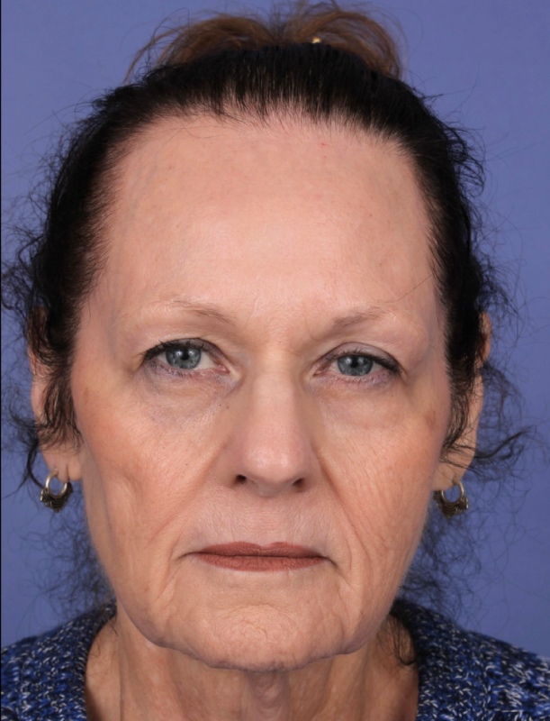 Facelift Before & After Image