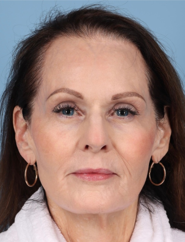 Facelift Before & After Image
