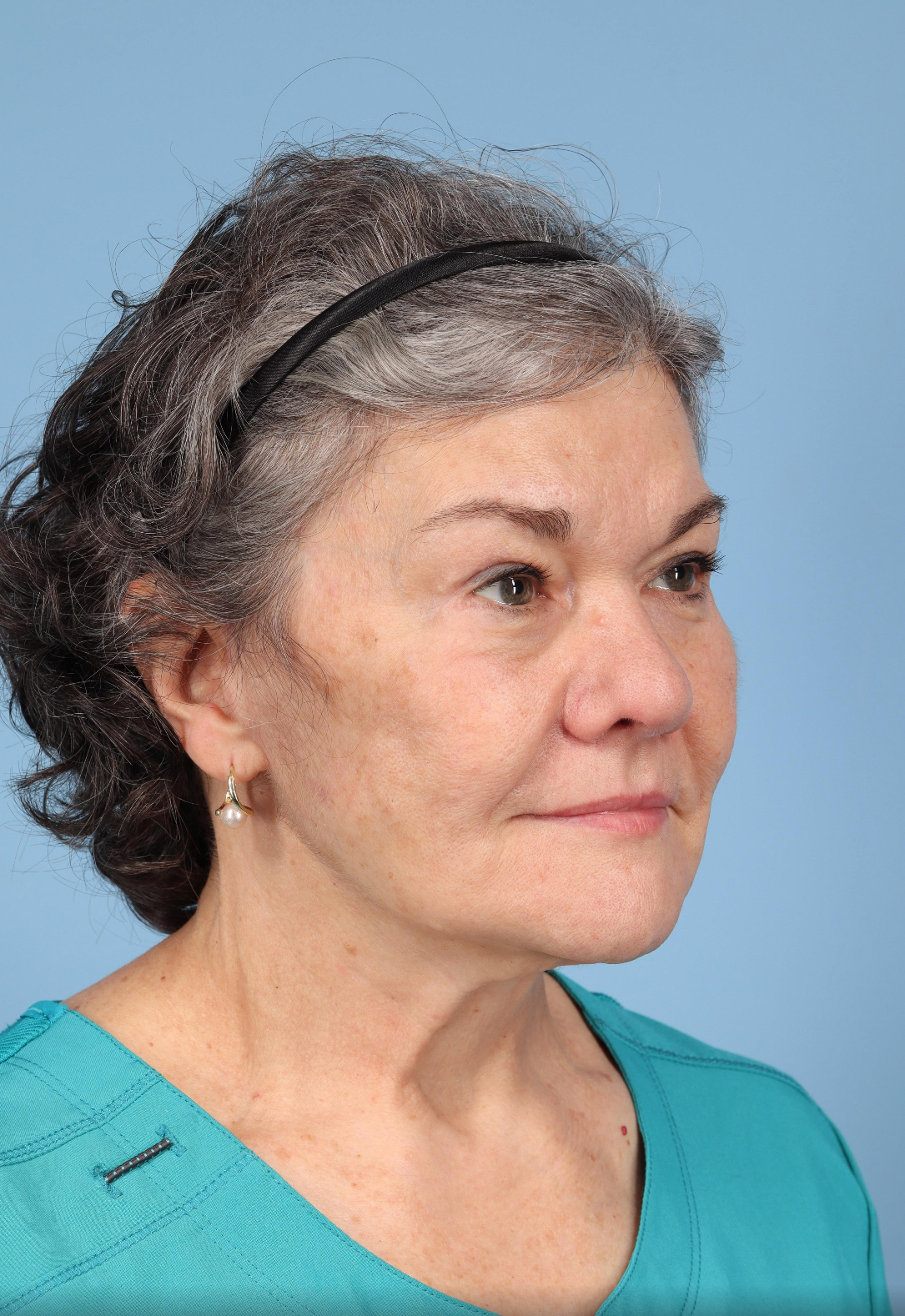 Facelift Before & After Image