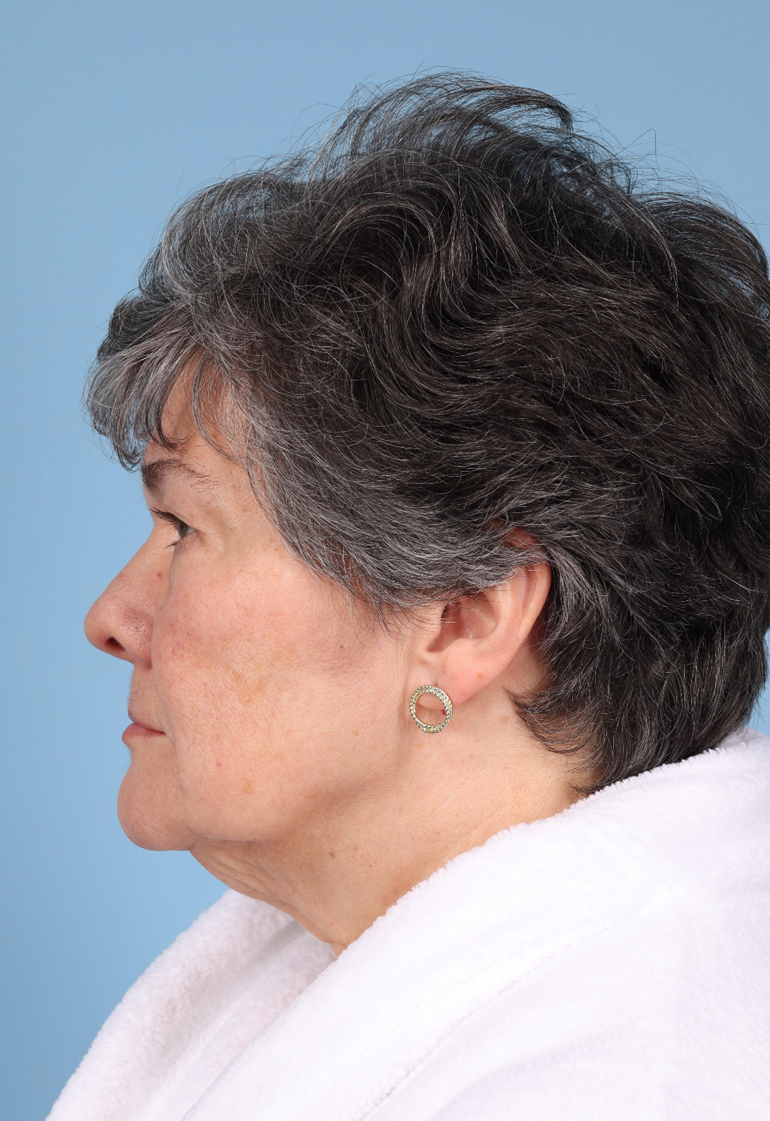 Facelift Before & After Image