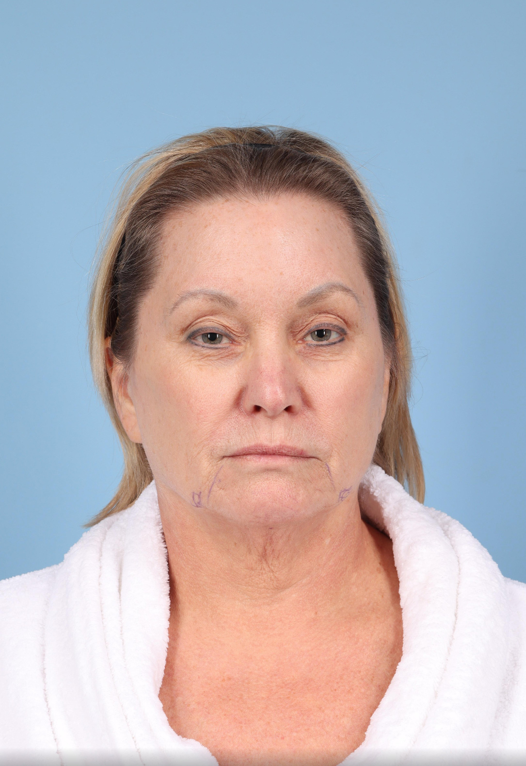Facelift Before & After Image