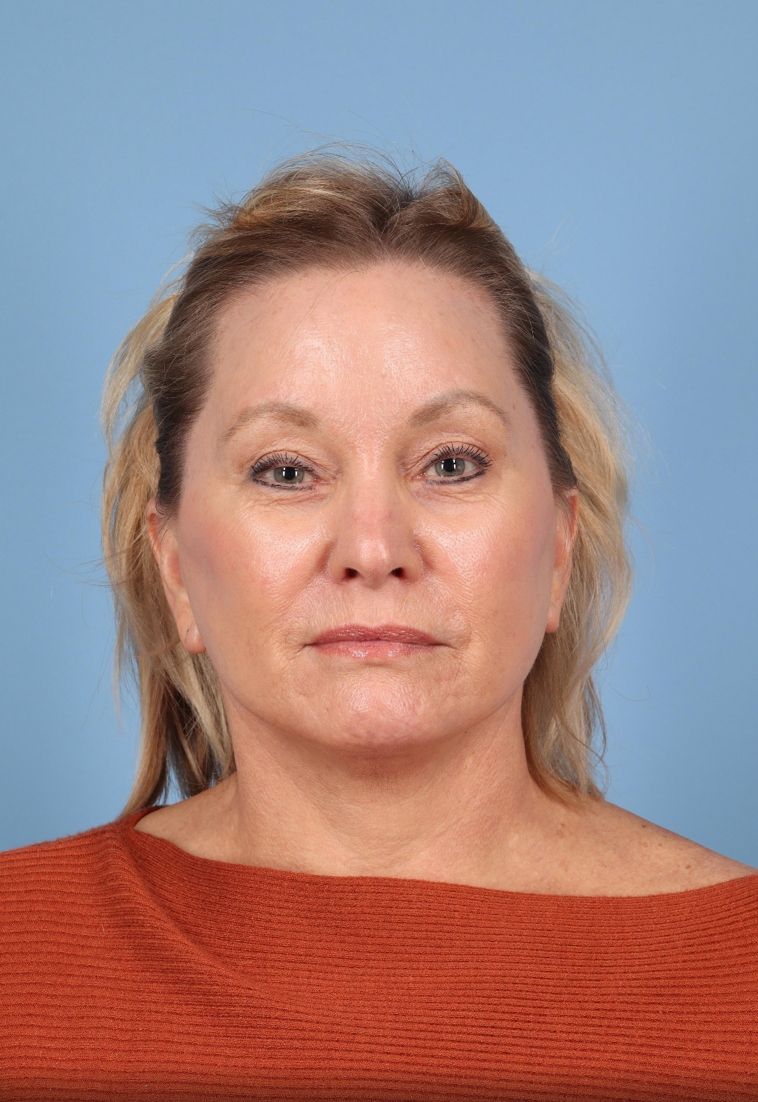 Facelift Before & After Image