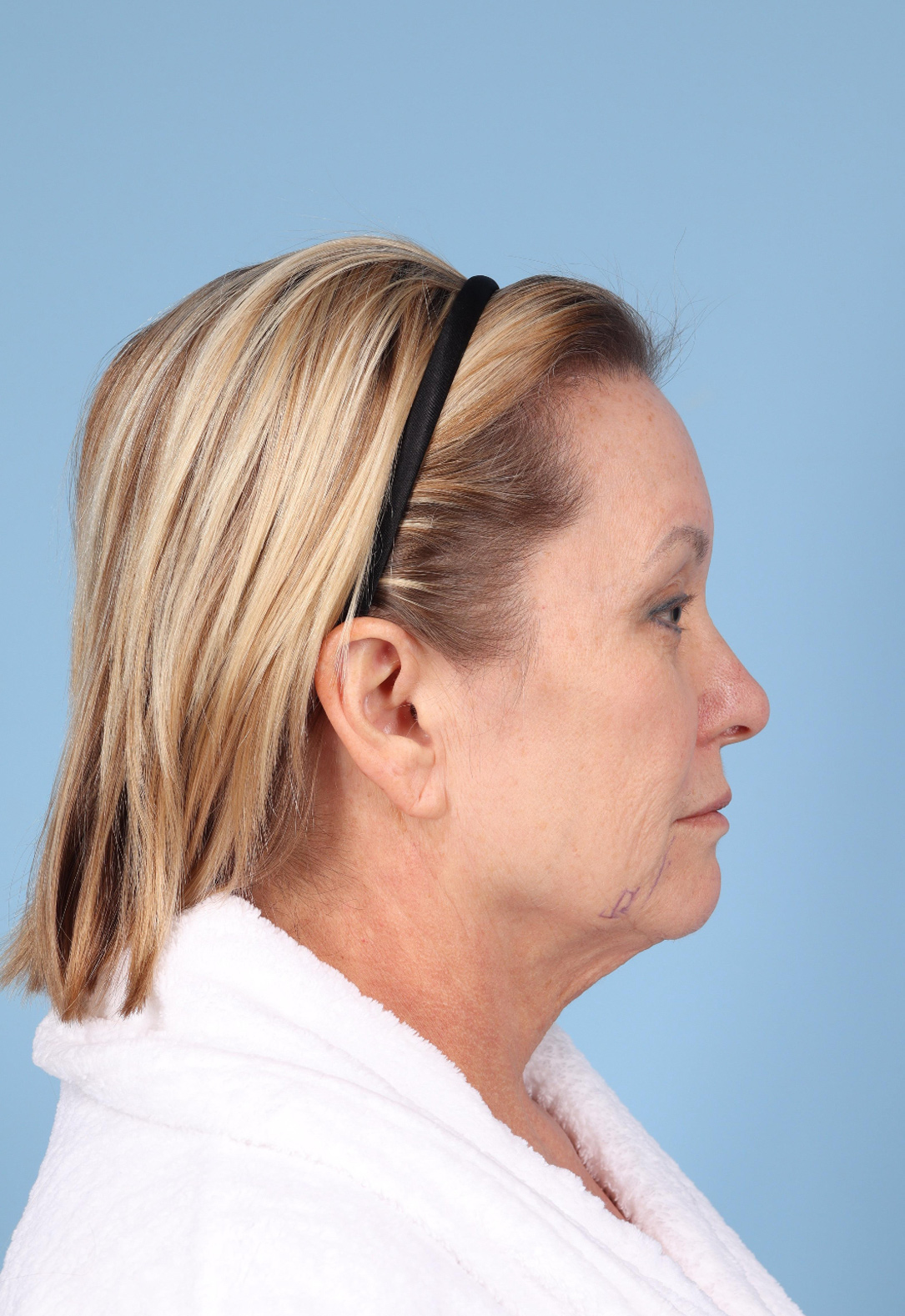 Facelift Before & After Image