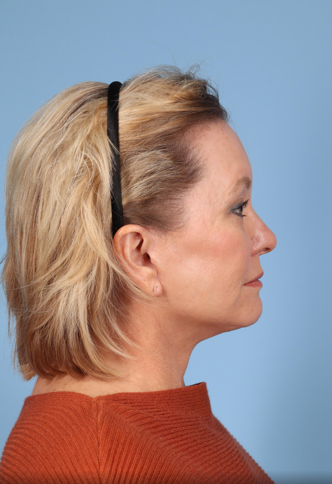 Facelift Before & After Image