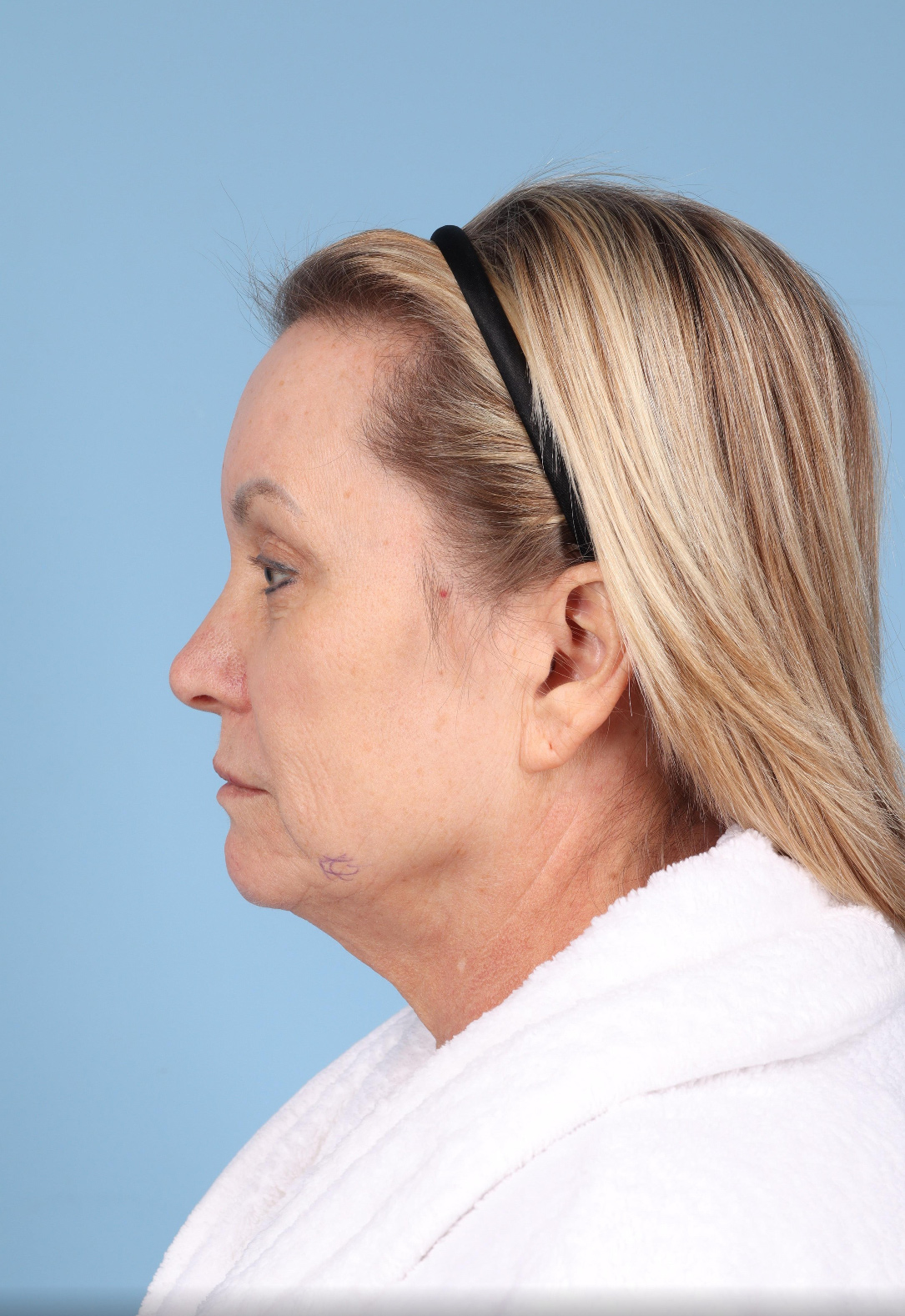 Facelift Before & After Image