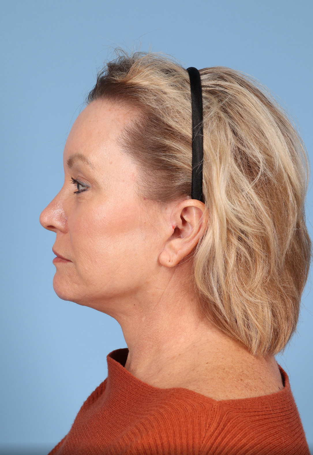 Facelift Before & After Image