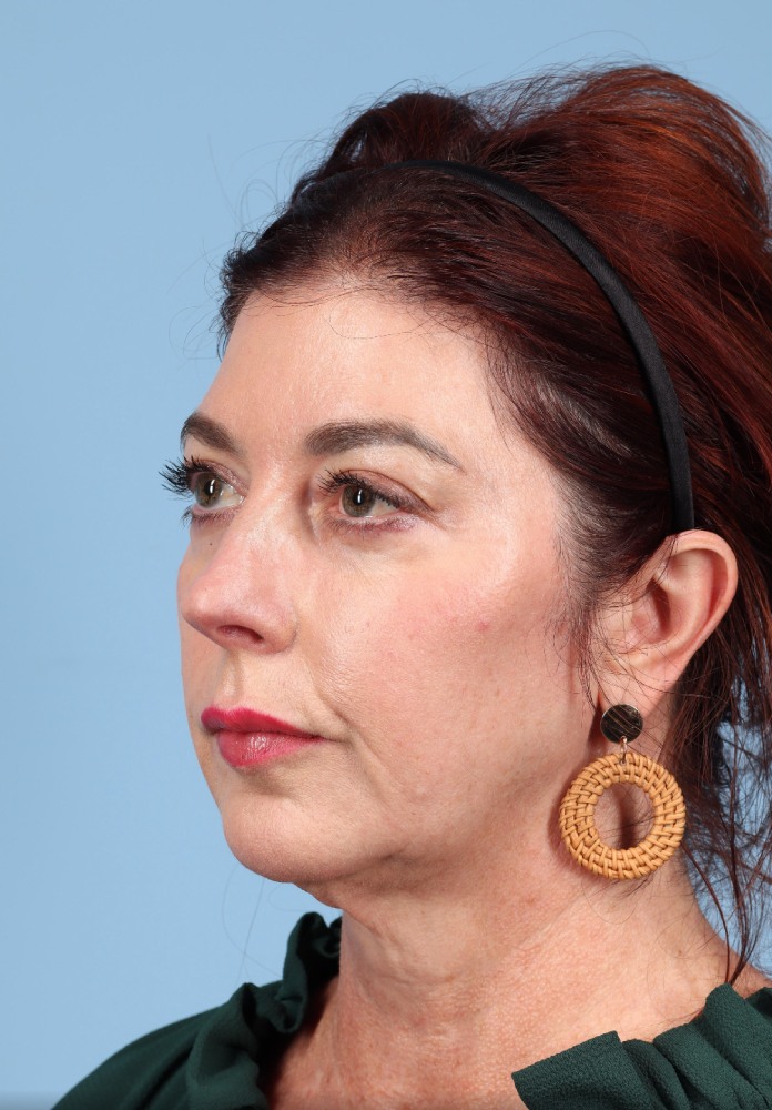 Facelift Before & After Image