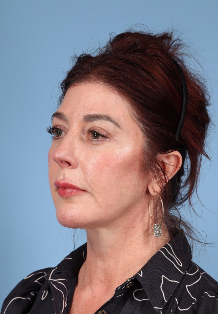 Facelift Before & After Image