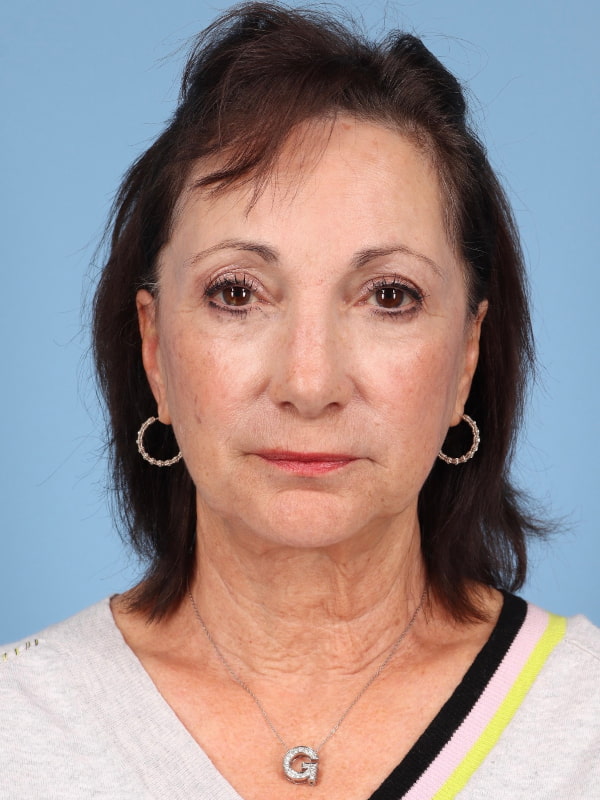 Facelift Before & After Image