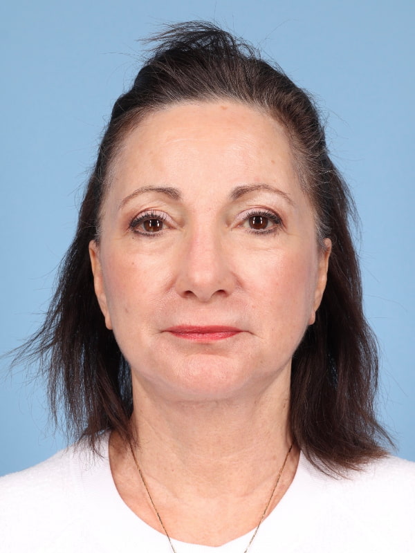 Facelift Before & After Image