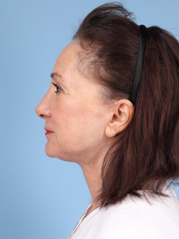 Facelift Before & After Image