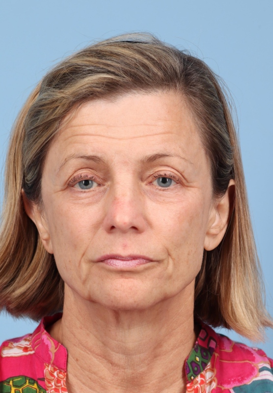 Facial Fat Grafting Before & After Image