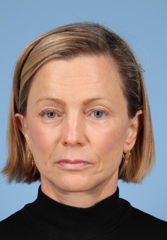 Facial Fat Grafting Before & After Image