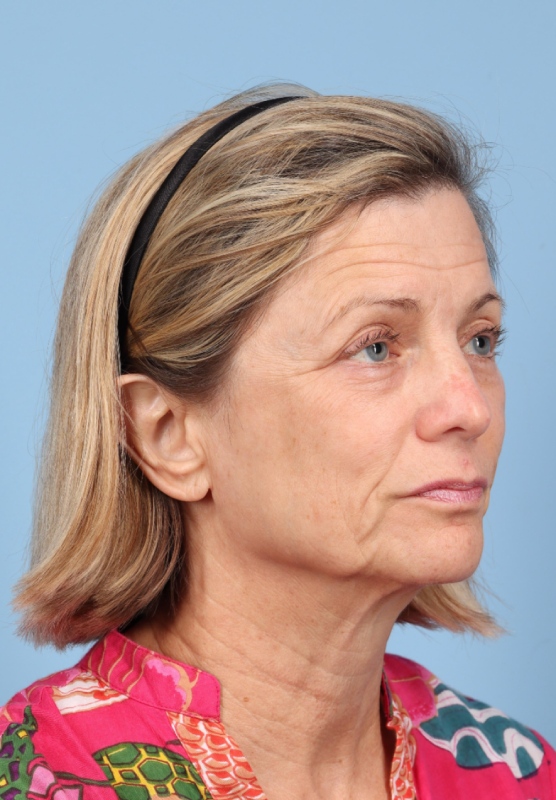 Facial Fat Grafting Before & After Image