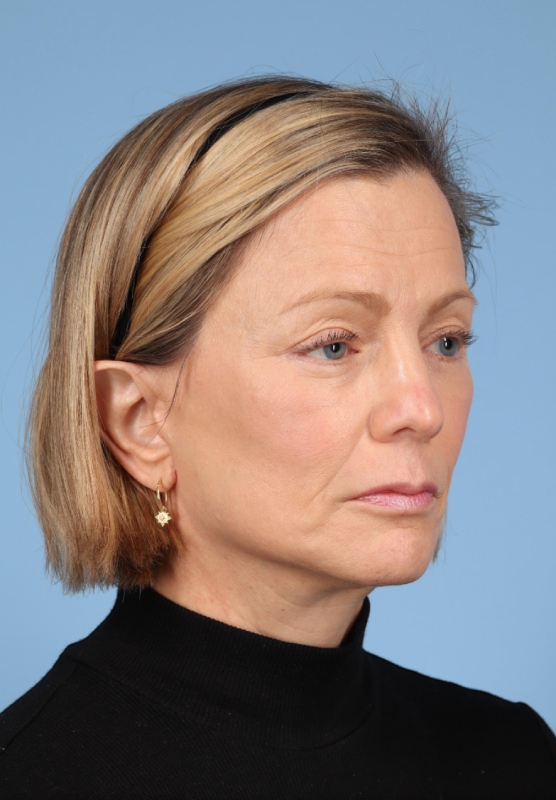 Facial Fat Grafting Before & After Image