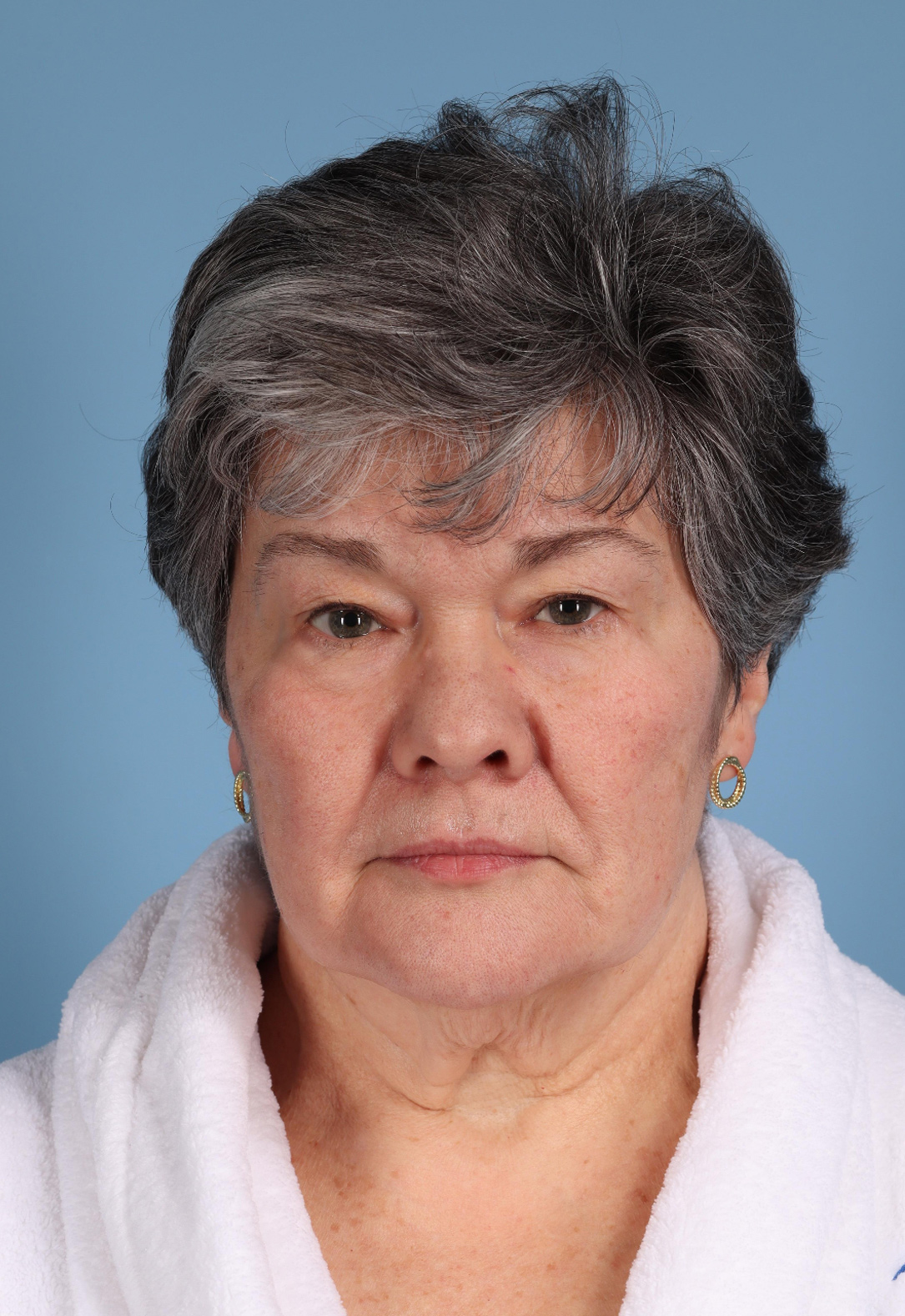 Neck Lift Before & After Image