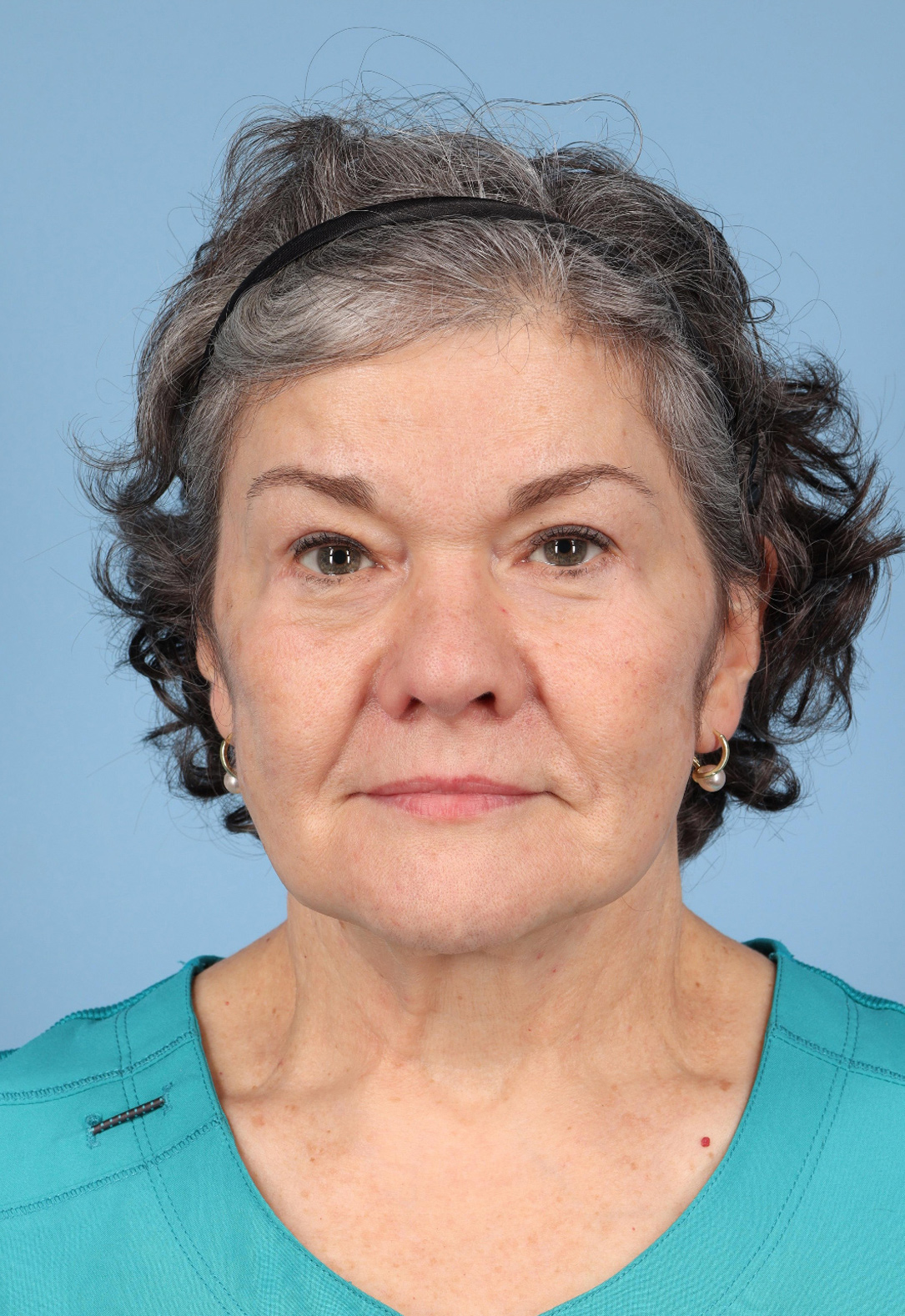 Neck Lift Before & After Image