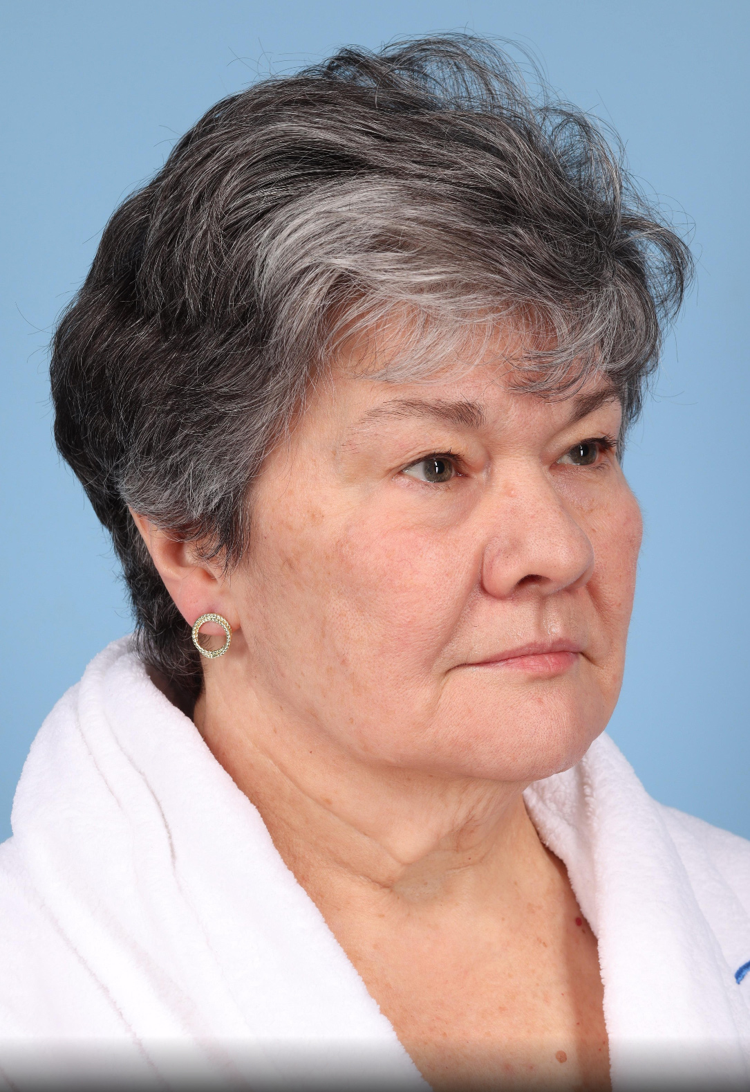 Neck Lift Before & After Image