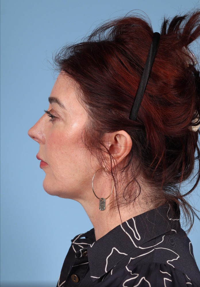 Neck Lift Before & After Image