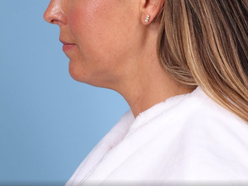 Neck Lift Before & After Image