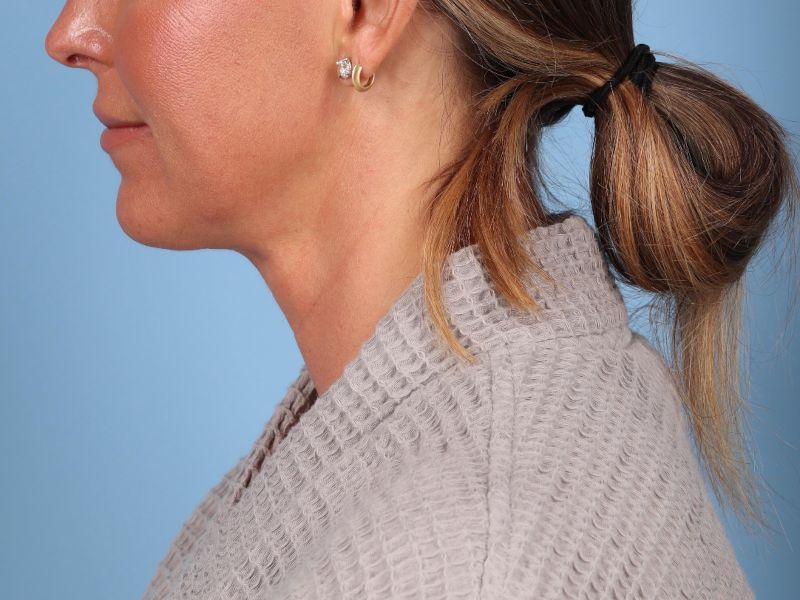 Neck Lift Before & After Image