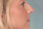 Rhinoplasty Before & After Image