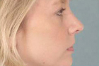 Rhinoplasty Before & After Image