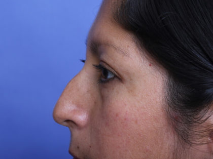 Rhinoplasty Before & After Image