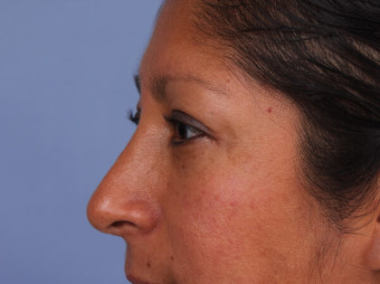 Rhinoplasty Before & After Image