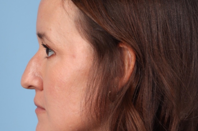 Rhinoplasty Before & After Image