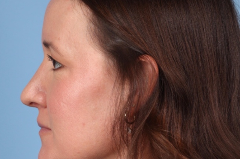 Rhinoplasty Before & After Image