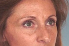 Laser Skin Rejuvenation Before & After Image