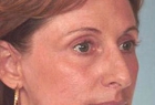 Laser Skin Rejuvenation Before & After Image