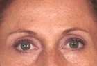 Laser Skin Rejuvenation Before & After Image